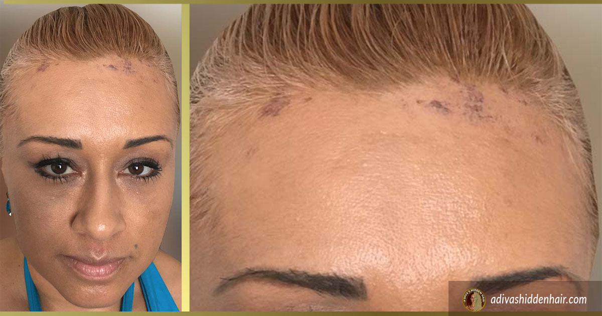Biopsy-proven traction alopecia involving the frontal and parietal scalp. |  Download Scientific Diagram
